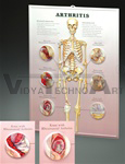 Arthritis 3D Lenticular Anatomical Chart